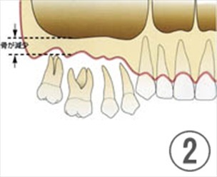 歯がなくなってしまうと骨が吸収して骨の高さが減少します。これではインプラントの手術ができません。（５ｍｍ以下）