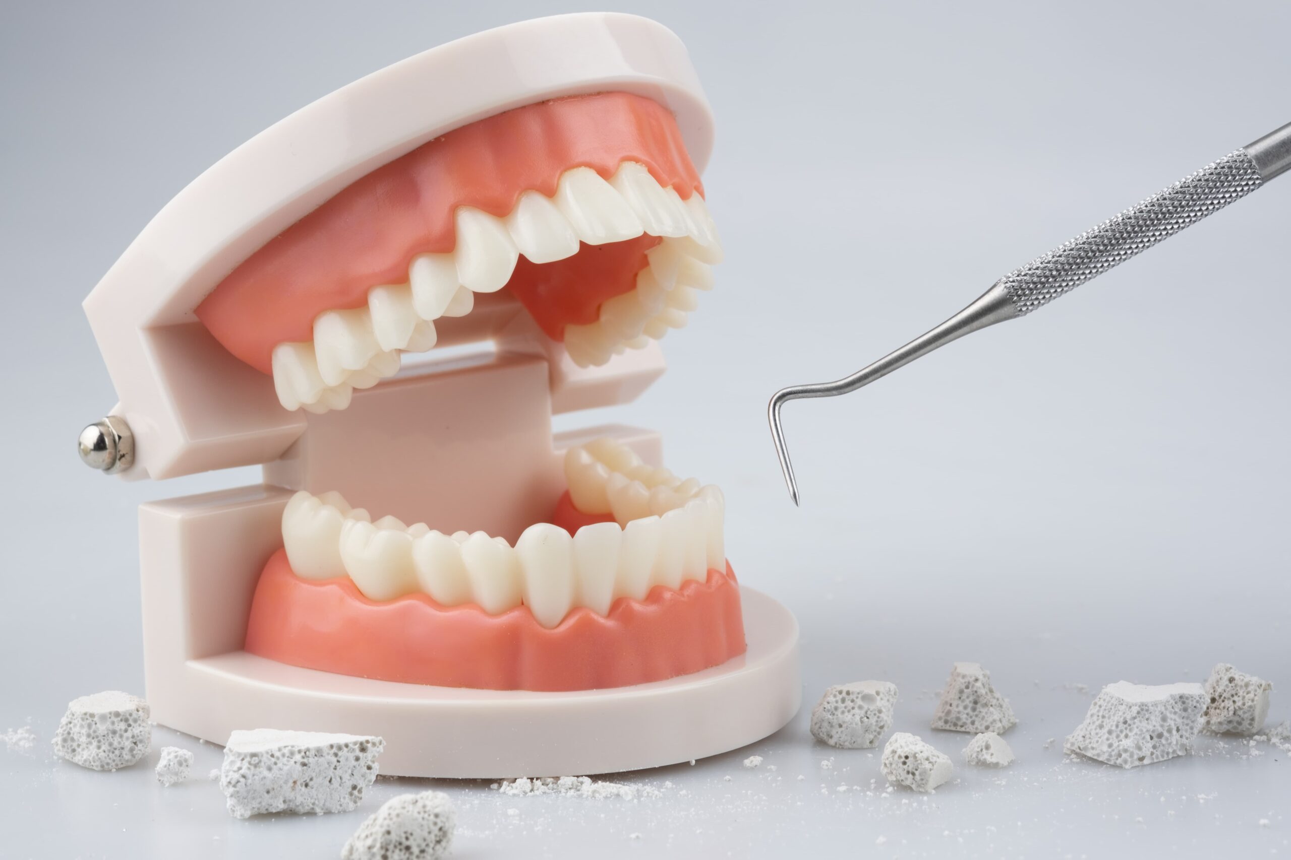 歯石除去のイメージ