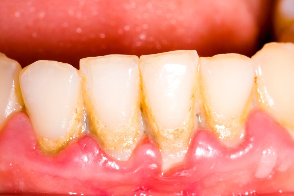 歯石が付いている人の歯