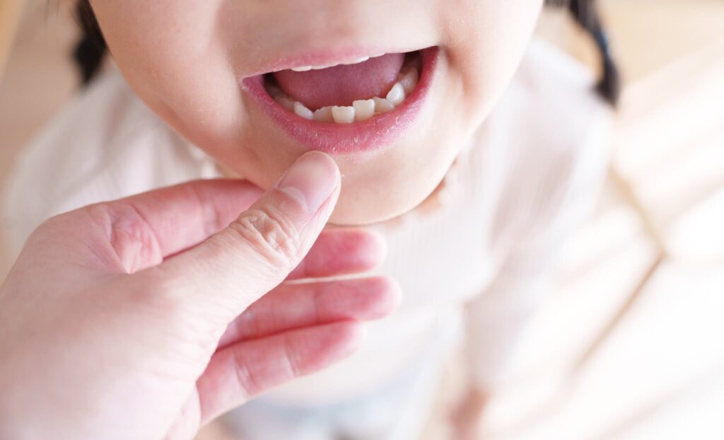 歯並びの軽度な乱れがある子どもの歯